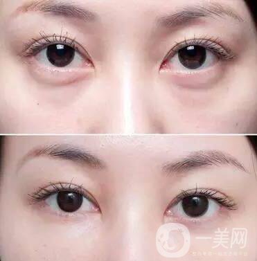 玻尿酸填充淚溝,玻尿酸填充淚溝價(jià)格