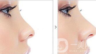 玻尿酸隆鼻多少錢