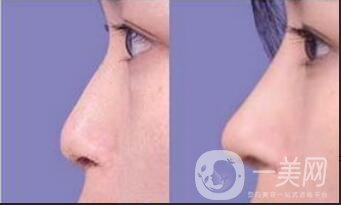 鼻翼縮小手術(shù)價(jià)格,鼻翼縮小