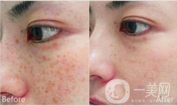 祛斑價位