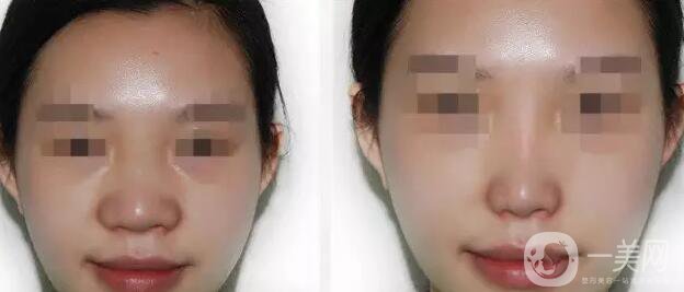 鼻翼縮小手術(shù)費用,鼻翼縮小價格