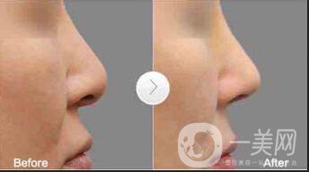 假體隆鼻多少錢