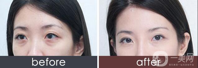 玻尿酸填充淚溝價(jià)格