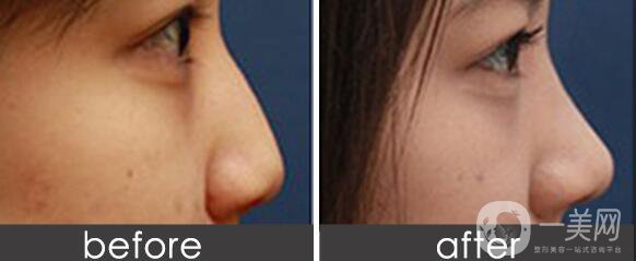 假體隆鼻多少錢