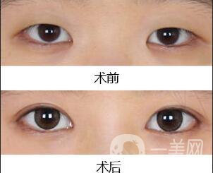 雙眼皮,開(kāi)眼角,雙眼皮開(kāi)眼角手術(shù)費(fèi)用