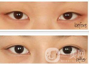 西安開眼角手術(shù)價(jià)格,開眼角手術(shù)價(jià)格,開眼角