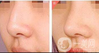 駝峰鼻矯正后遺癥