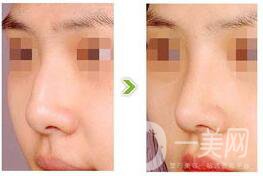 駝峰鼻矯正注意事項(xiàng)