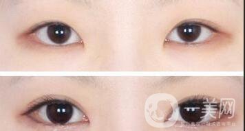 開眼角醫(yī)院