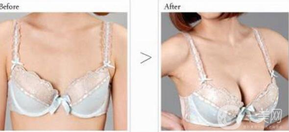 抽脂豐胸多少錢(qián)