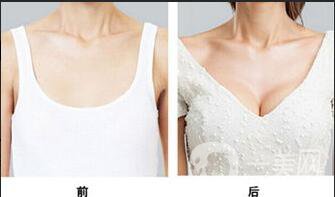 抽脂隆胸多少錢(qián)