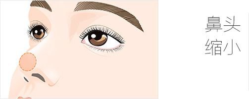 鼻頭縮小術(shù)注意事項