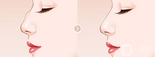 駝峰鼻矯正的價格