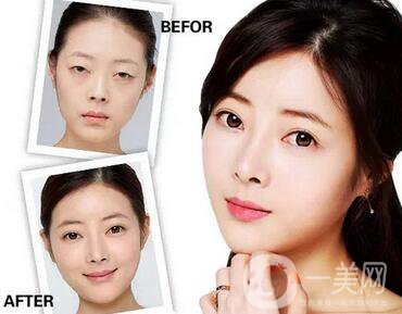 生物焊接雙眼皮價格是多少 貴不貴