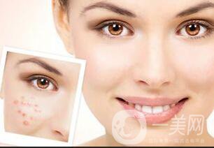 光子嫩膚優(yōu)勢