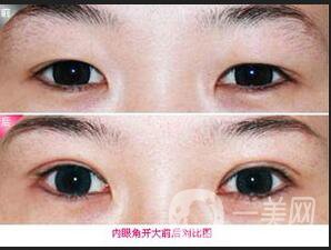 開(kāi)眼角風(fēng)險(xiǎn)