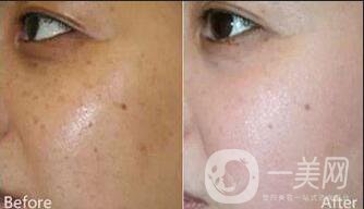 c6激光祛斑多少錢