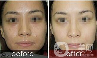 黑臉娃娃縮小毛孔多少錢