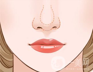 鼻翼縮小價(jià)錢