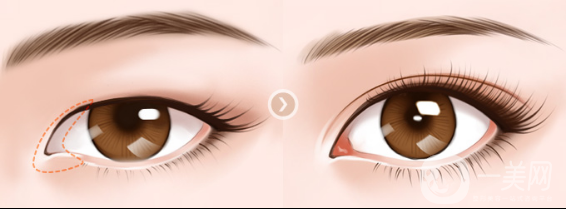 韓式*開眼角價(jià)格