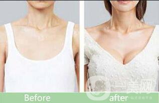 妙桃假體豐胸,假體豐胸價(jià)格,妙桃假體豐胸價(jià)格