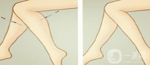 打*多少錢(qián)