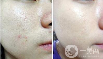 果酸換膚多少錢