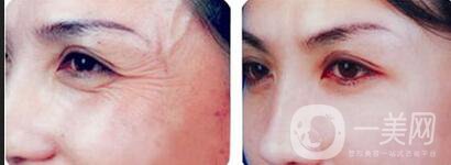 除皺方式 除皺價(jià)格