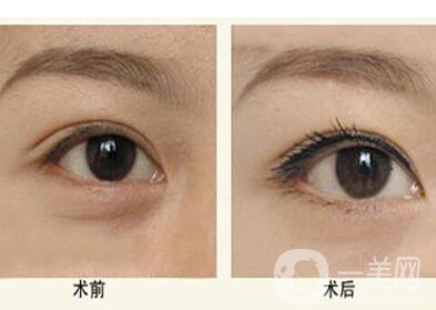 超聲法去眼袋,超聲法去眼袋價(jià)格