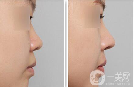 自體隆鼻多少錢