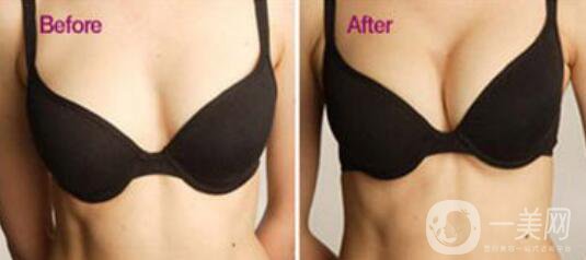 自體豐胸手術(shù)費(fèi)用