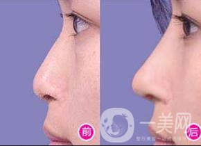 玻尿酸隆鼻價格,玻尿酸隆鼻價位