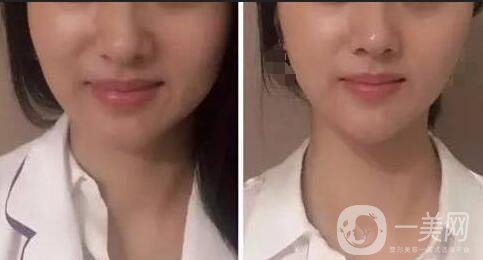 *瘦臉報(bào)價(jià)