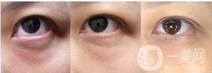 激光去黑眼圈修復(fù)價(jià)格 