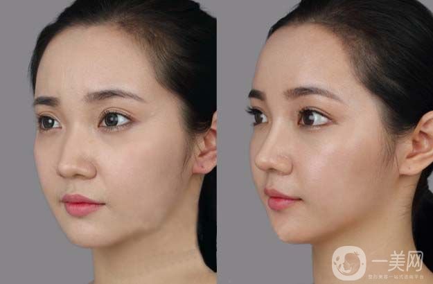 隆鼻整形費(fèi)用