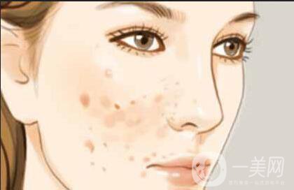 c6激光祛斑貴嗎 術(shù)后如何護(hù)理