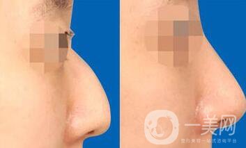 駝峰鼻矯正,價(jià)格