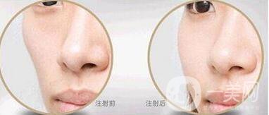 自體脂肪填充臉頰多少錢