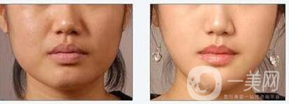 墊下巴手術(shù)方式