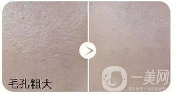 彩光嫩膚手術價格