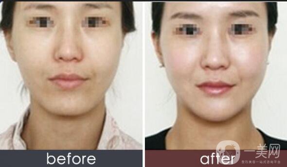 超聲法瘦臉,超聲法瘦臉價格