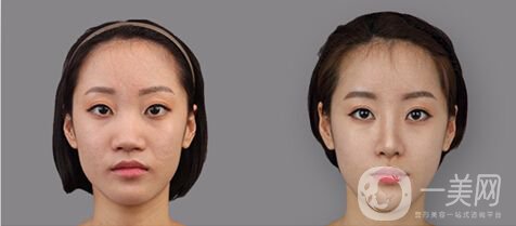 鼻頭縮小術(shù)注意事項(xiàng),手術(shù)縮鼻頭有用嗎