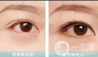 半*美瞳線價(jià)格