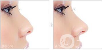 耳軟骨隆鼻整形價格