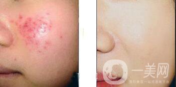 廣東果酸嫩膚價格