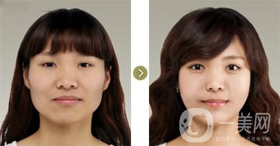 下頜角手術(shù)后遺癥都有哪些呢？