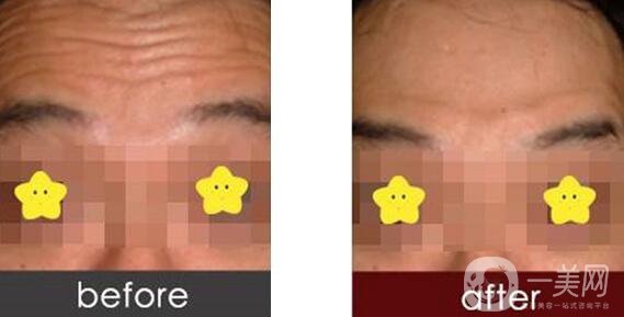 抬頭紋如何形成的 抬頭紋很深怎么辦？