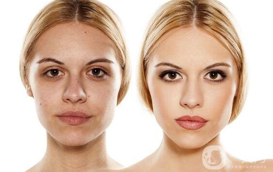 光子嫩膚是什么 價格多少？