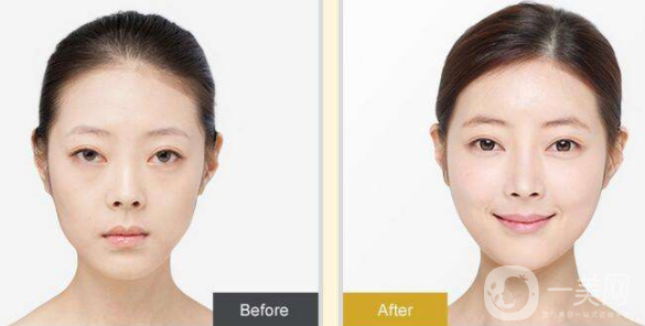 割雙眼皮跟埋線有什么不一樣 區(qū)別是什么呢