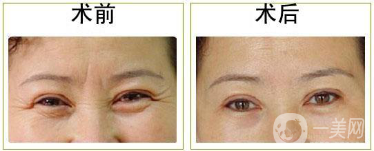 怎么去魚尾紋 去魚尾紋的方法